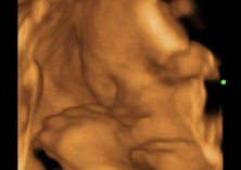 ultrazvuk, dieťa, vierka